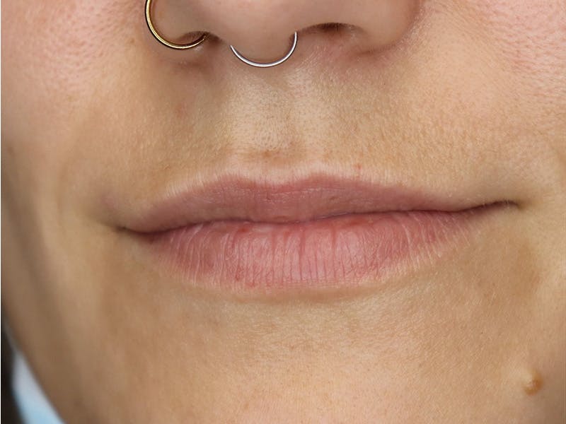 Lip Filler Before & After Gallery - Patient 87555349 - Image 5