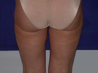 Liposuction Before & After Gallery - Patient 87555350 - Image 2