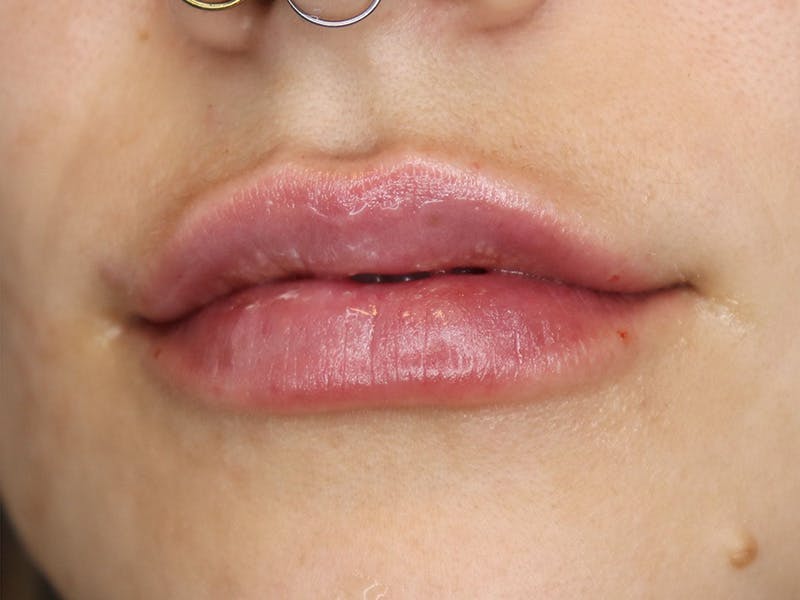 Lip Filler Before & After Gallery - Patient 87555349 - Image 6