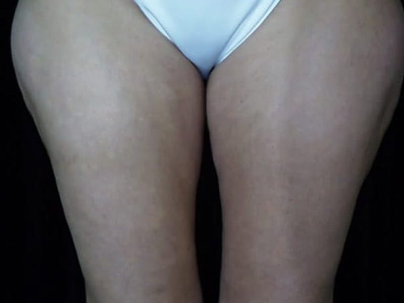 Liposuction Before & After Gallery - Patient 87555350 - Image 3