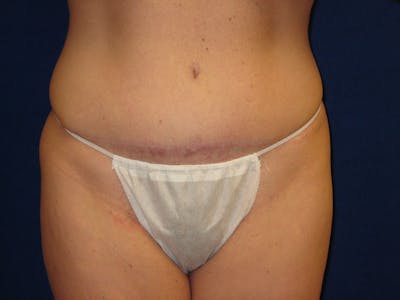 Tummy Tuck Before & After Gallery - Patient 87555354 - Image 2