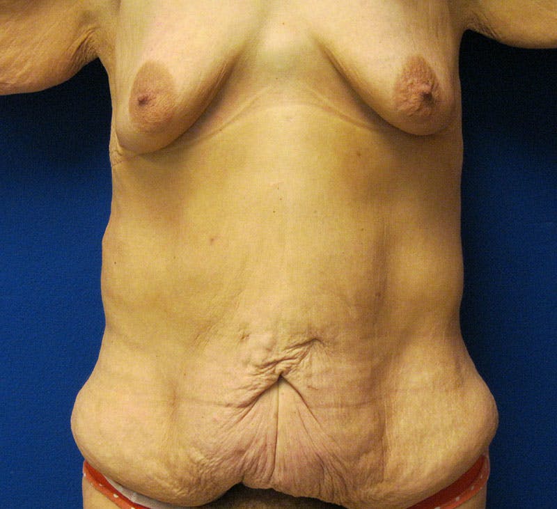 Corset Lift Before & After Gallery - Patient 87555371 - Image 1