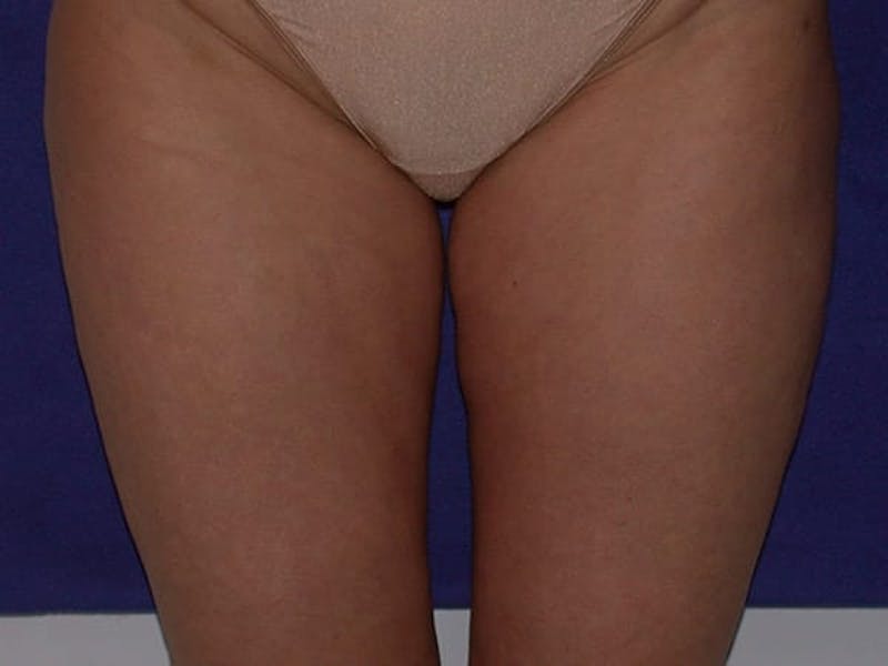 Liposuction Before & After Gallery - Patient 87555350 - Image 4