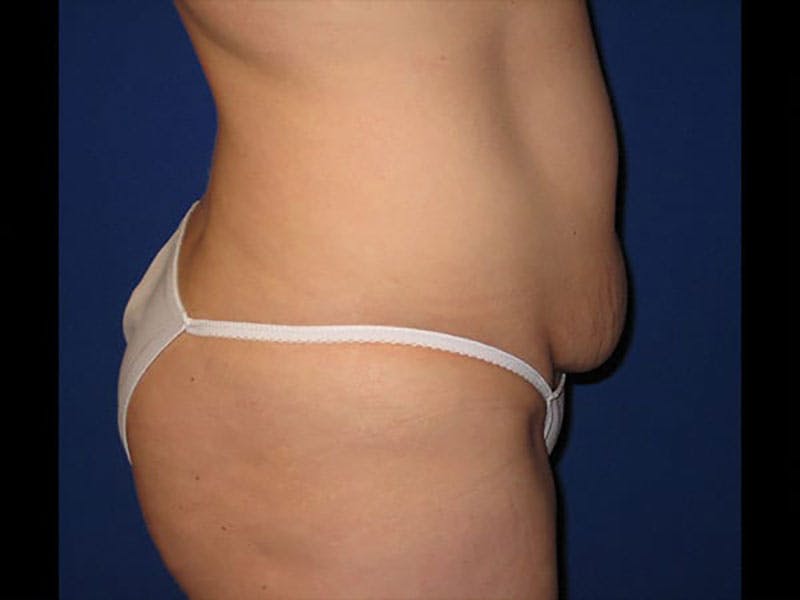 Tummy Tuck Before & After Gallery - Patient 87555354 - Image 3
