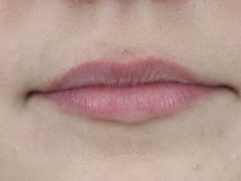 Lip Filler Before & After Gallery - Patient 87555374 - Image 1