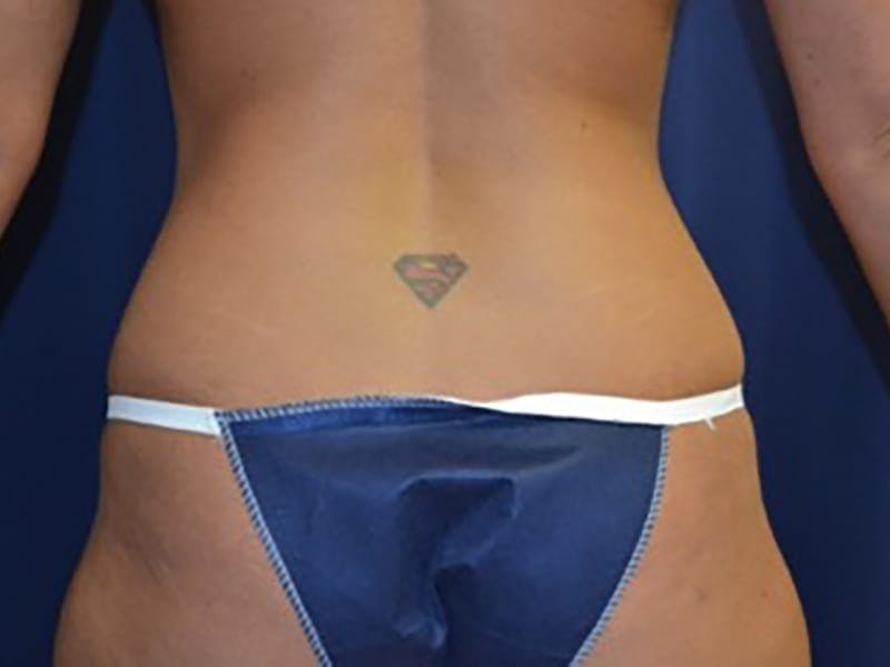 Liposuction Before & After Gallery - Patient 87555356 - Image 1