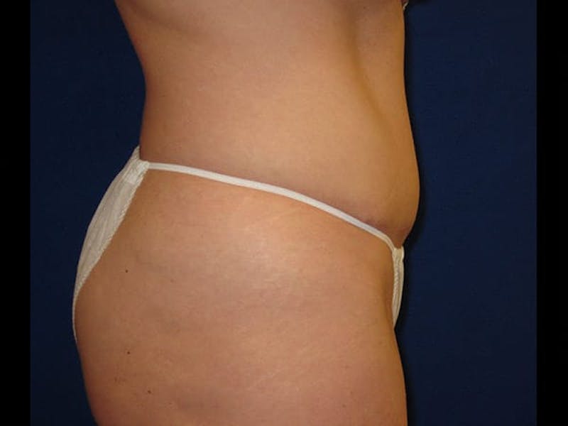 Tummy Tuck Before & After Gallery - Patient 87555354 - Image 4
