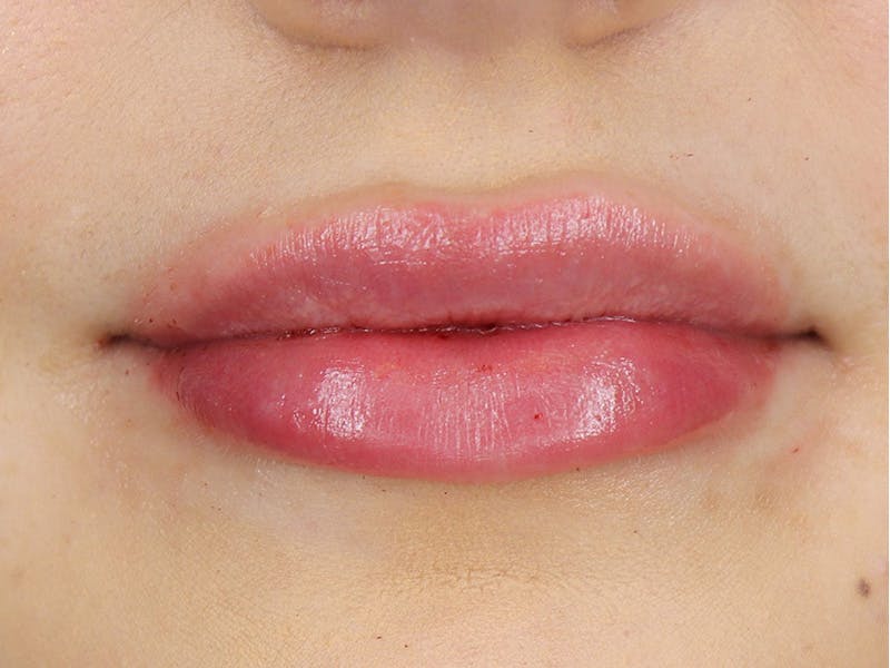 Lip Filler Before & After Gallery - Patient 87555374 - Image 2