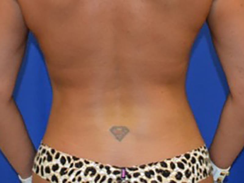 Liposuction Before & After Gallery - Patient 87555356 - Image 2