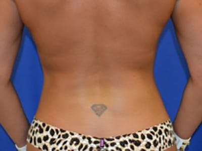 Liposuction Before & After Gallery - Patient 87555356 - Image 2
