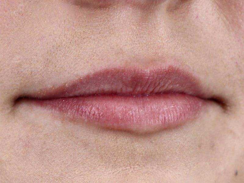 Lip Filler Before & After Gallery - Patient 87555374 - Image 3