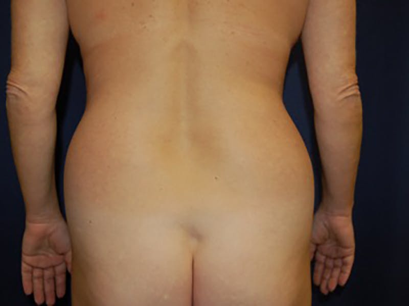 Liposuction Before & After Gallery - Patient 87555370 - Image 1
