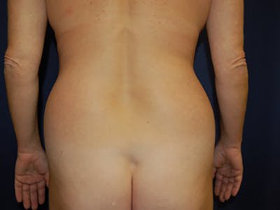 Liposuction Before & After Gallery - Patient 87555370 - Image 1