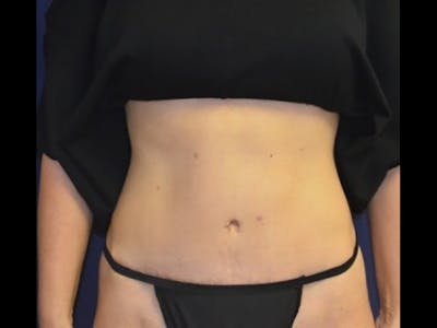 Tummy Tuck Before & After Gallery - Patient 87555373 - Image 2