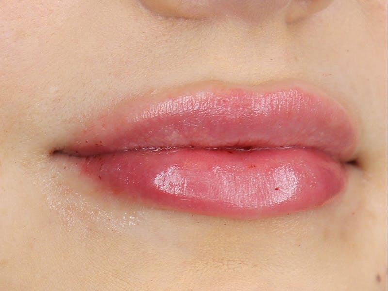 Lip Filler Before & After Gallery - Patient 87555374 - Image 4
