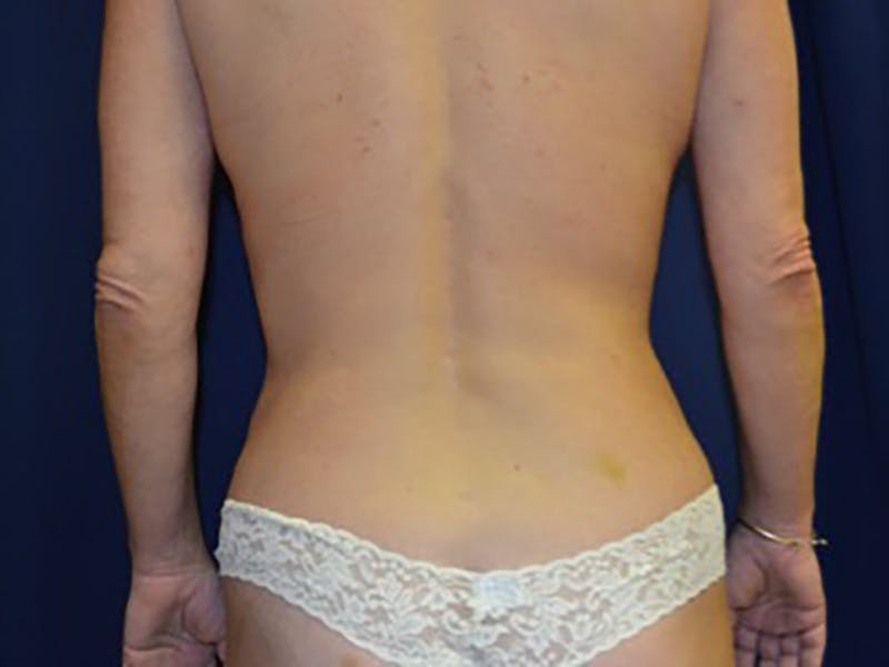 Liposuction Before & After Gallery - Patient 87555370 - Image 2