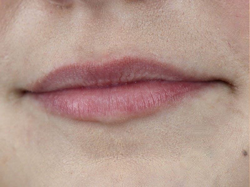 Lip Filler Before & After Gallery - Patient 87555374 - Image 5