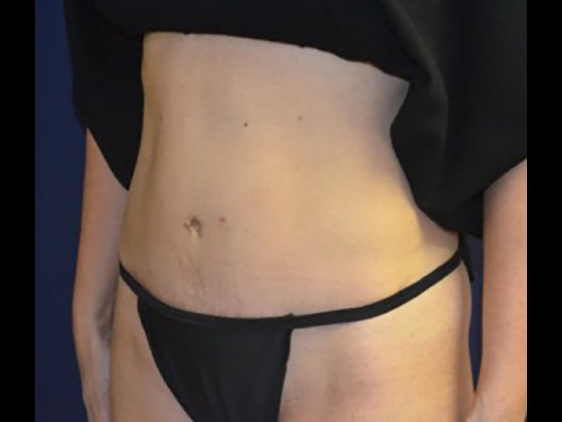 Tummy Tuck Before & After Gallery - Patient 87555373 - Image 4
