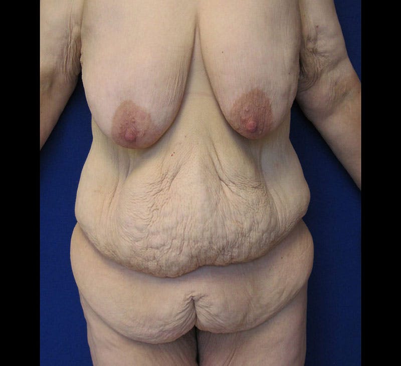 Corset Lift Before & After Gallery - Patient 87555377 - Image 1