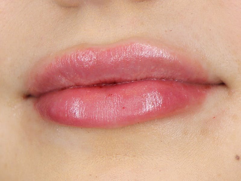 Lip Filler Before & After Gallery - Patient 87555374 - Image 6