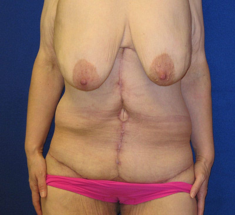 Corset Lift Before & After Gallery - Patient 87555377 - Image 2