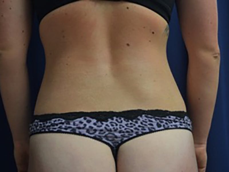 Liposuction Before & After Gallery - Patient 87555391 - Image 2