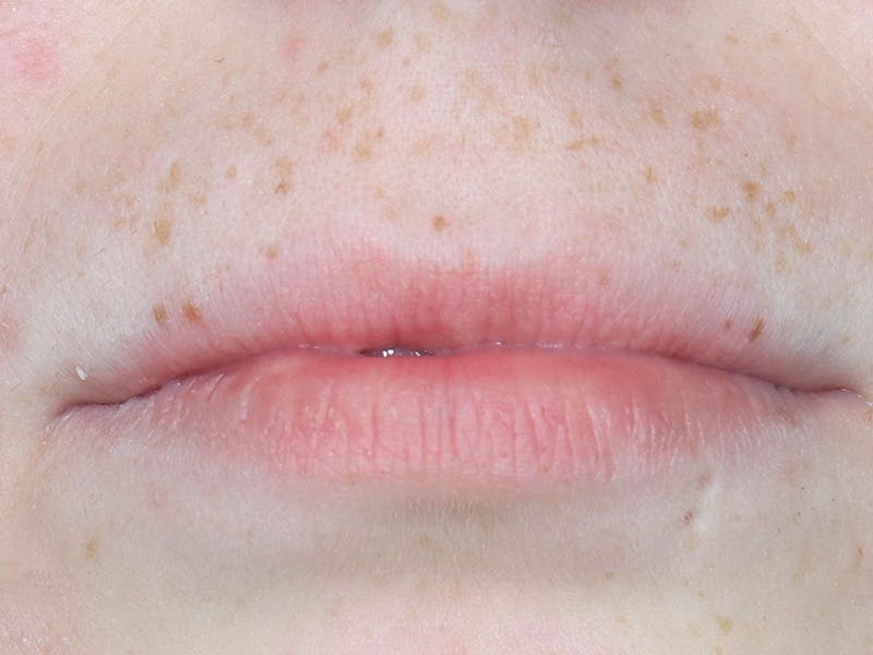 Lip Filler Before & After Gallery - Patient 87555378 - Image 1