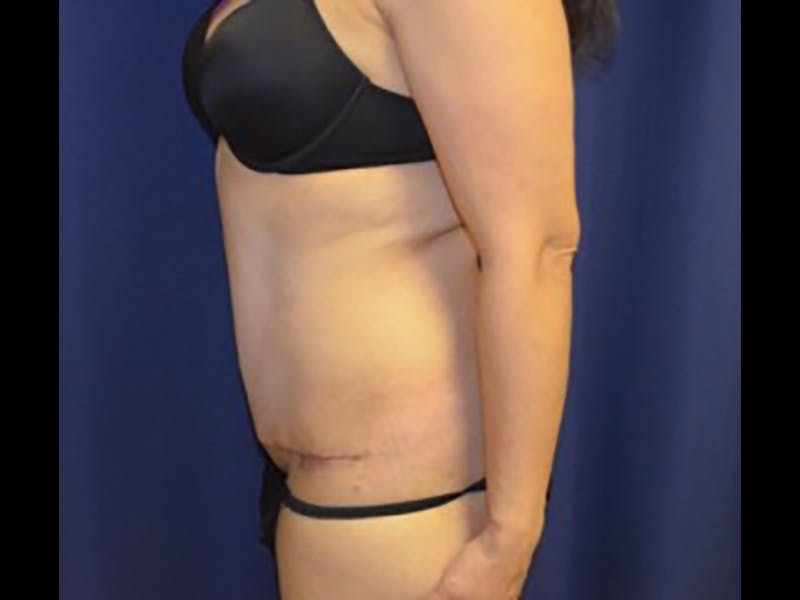 Tummy Tuck Before & After Gallery - Patient 87555376 - Image 2