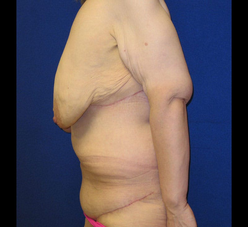 Corset Lift Before & After Gallery - Patient 87555377 - Image 4