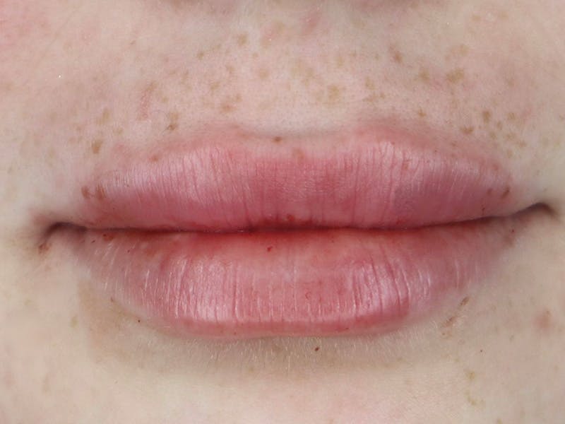 Lip Filler Before & After Gallery - Patient 87555378 - Image 2
