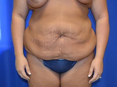 Tummy Tuck Before & After Gallery - Patient 87555390 - Image 1