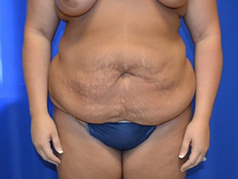 Tummy Tuck Before & After Gallery - Patient 87555390 - Image 1