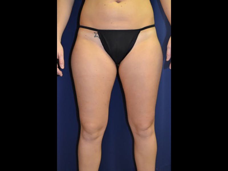 Liposuction Before & After Gallery - Patient 87555391 - Image 5