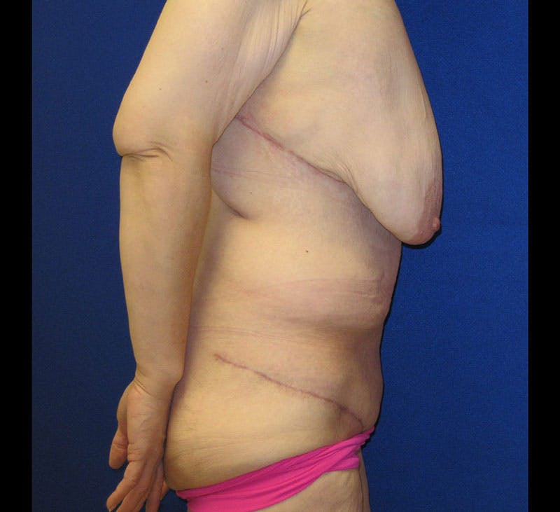 Corset Lift Before & After Gallery - Patient 87555377 - Image 6