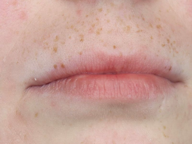 Lip Filler Before & After Gallery - Patient 87555378 - Image 3