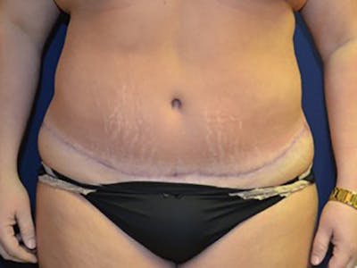 Tummy Tuck Before & After Gallery - Patient 87555390 - Image 2