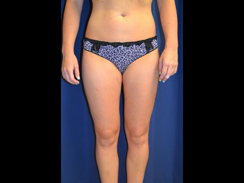 Liposuction Before & After Gallery - Patient 87555391 - Image 6