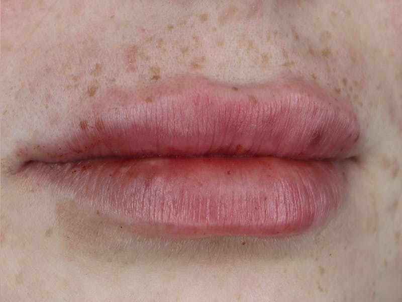 Lip Filler Before & After Gallery - Patient 87555378 - Image 4