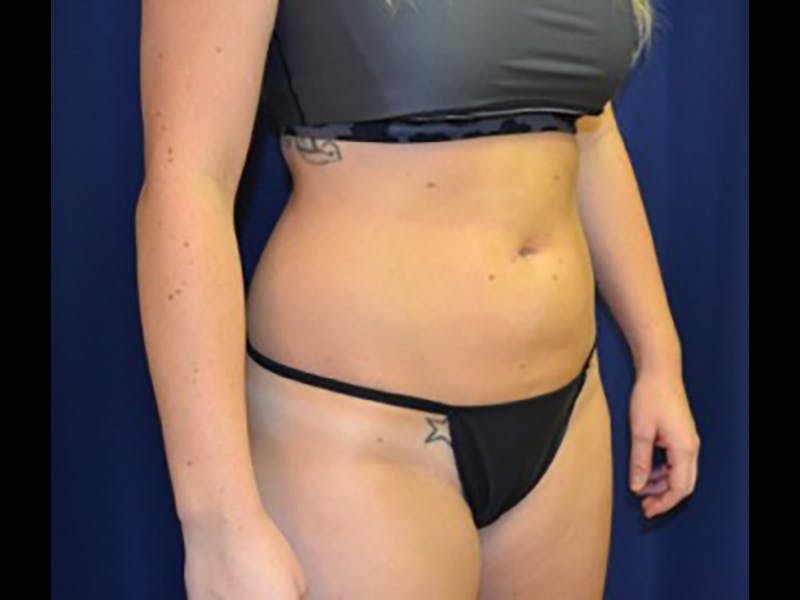 Liposuction Before & After Gallery - Patient 87555391 - Image 7
