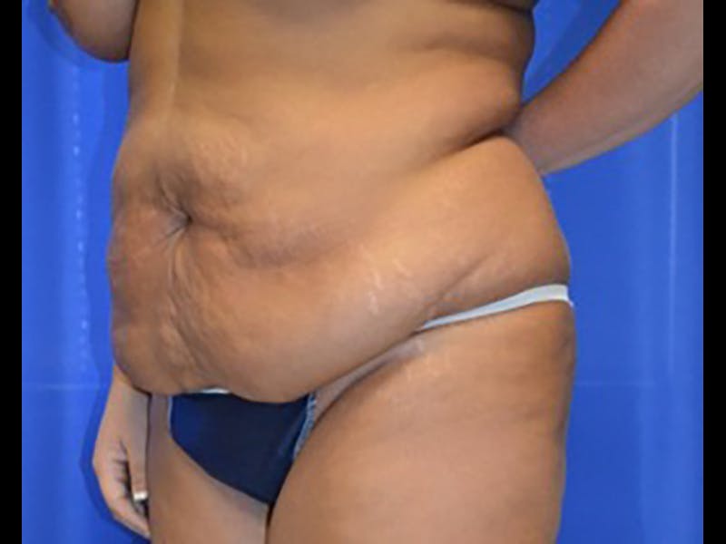 Tummy Tuck Before & After Gallery - Patient 87555390 - Image 3