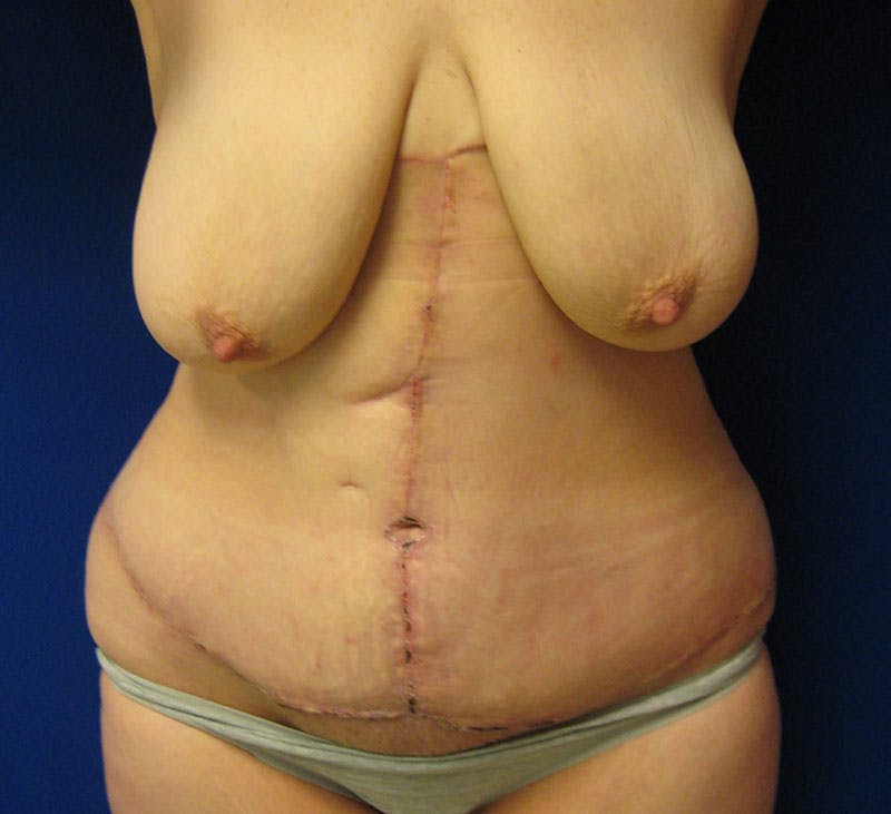 Corset Lift Before & After Gallery - Patient 87555392 - Image 2