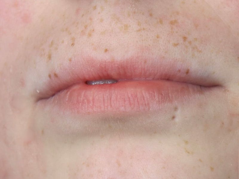 Lip Filler Before & After Gallery - Patient 87555378 - Image 5
