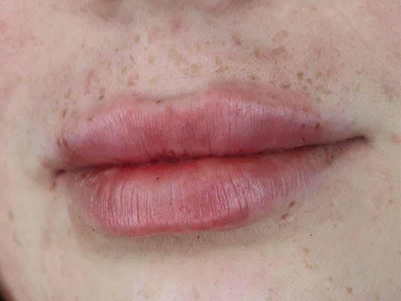 Lip Filler Before & After Gallery - Patient 87555378 - Image 6