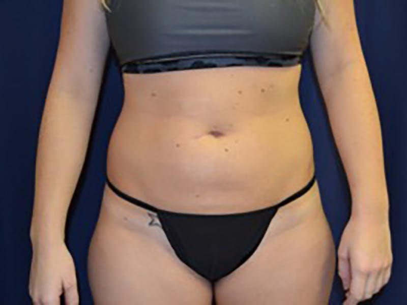 Liposuction Before & After Gallery - Patient 87555391 - Image 9