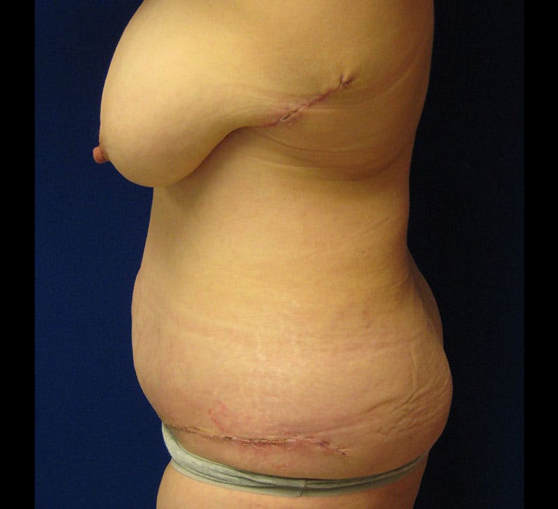 Corset Lift Before & After Gallery - Patient 87555392 - Image 4