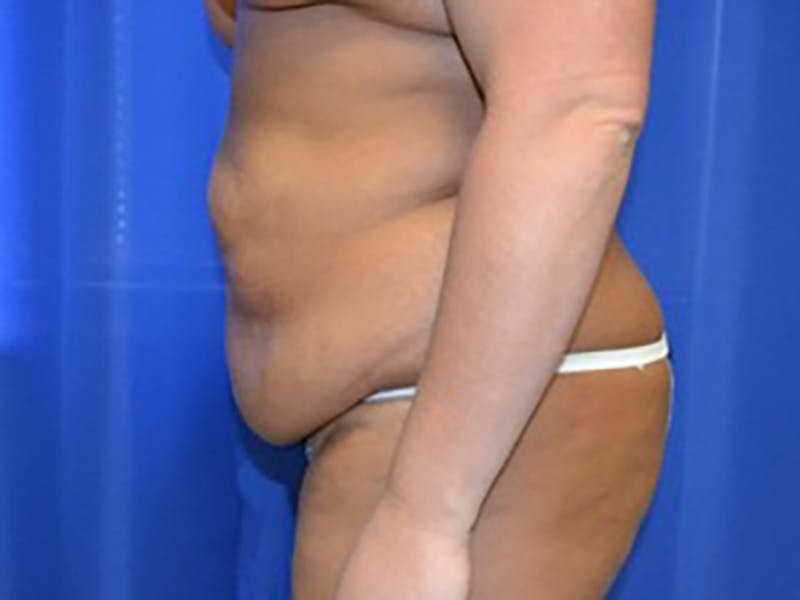 Tummy Tuck Before & After Gallery - Patient 87555390 - Image 5