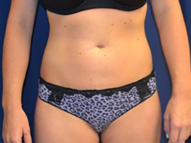 Liposuction Before & After Gallery - Patient 87555391 - Image 10