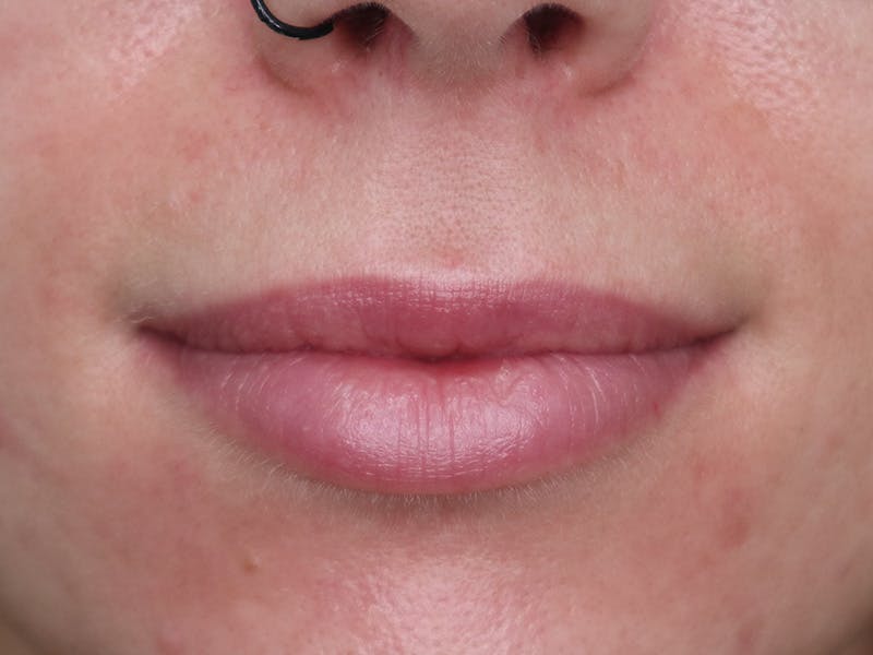 Lip Filler Before & After Gallery - Patient 87555393 - Image 1