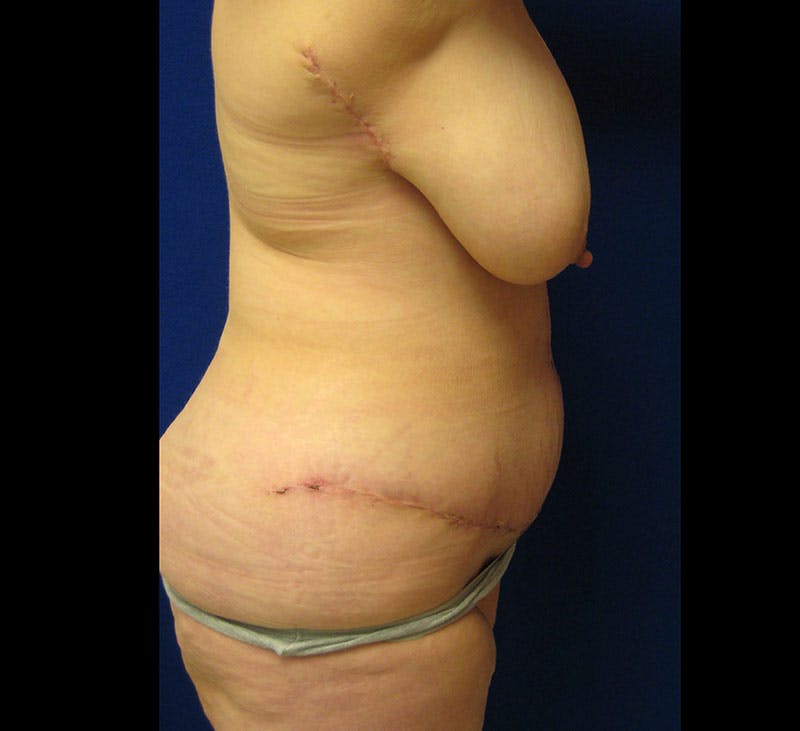 Corset Lift Before & After Gallery - Patient 87555392 - Image 6