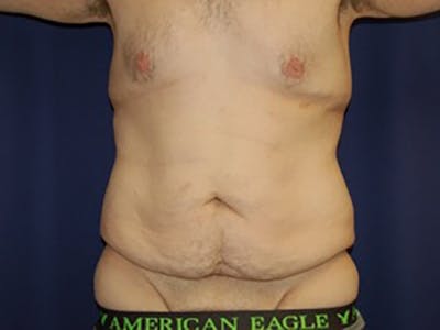 Tummy Tuck Before & After Gallery - Patient 87555398 - Image 1